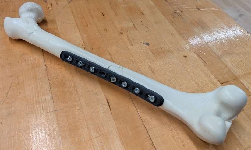 Gen 2 fracture plate installed on femur model